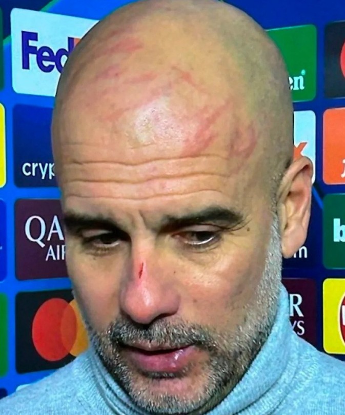 ▲ 페예노르트전이 끝난 후 생채기가 난 얼굴로 등장한 과르디올라 감독 ⓒ데일리 메일