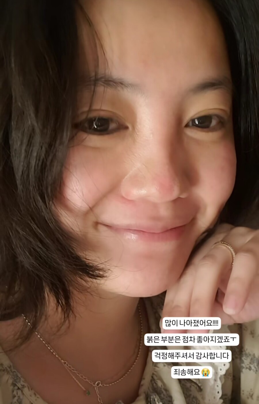 고은아, 안면부상 후 근황 