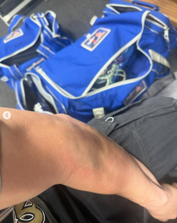 ▲ 올해 LA 다저스의 월드시리즈 우승에 기여한 엔리케 에르난데스가 팔꿈치 수술을 받았다. 사진은 그가 공개한 포스트시즌 당시 팔꿈치 모습 ⓒ엔리케 에르난데스 SNS